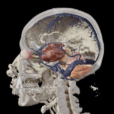 Editorial: Endoscopic transorbital surgery for skull base tumors
